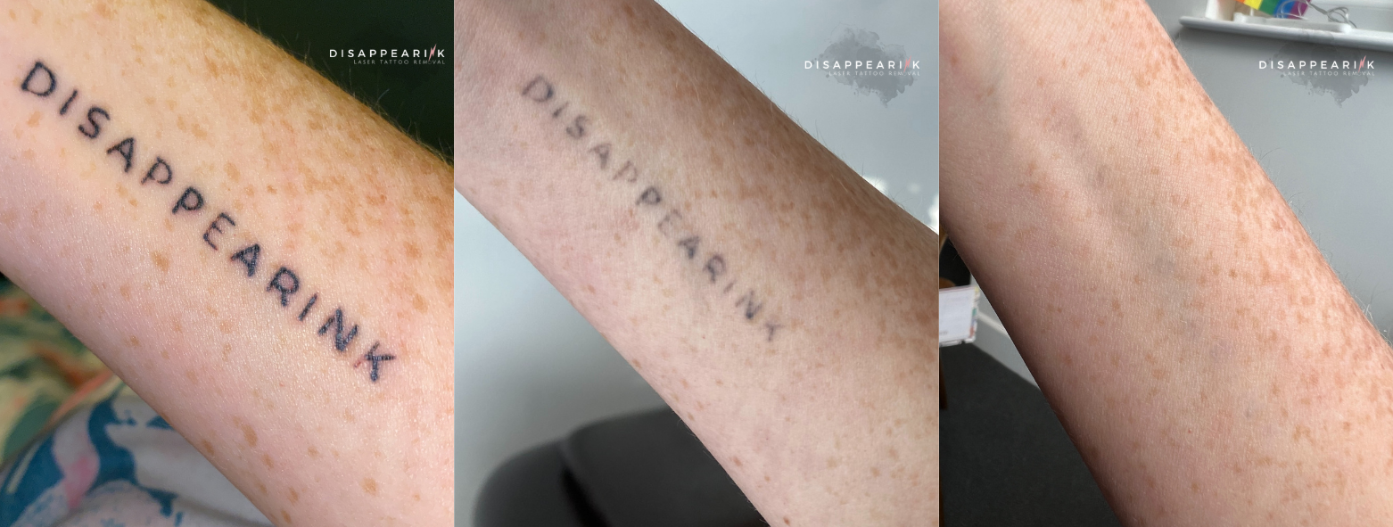 Why is Laser Tattoo Removal Not Fading My Tattoo? | Removery